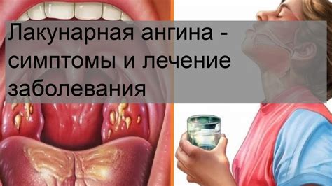 Лечение ангины: основные меры