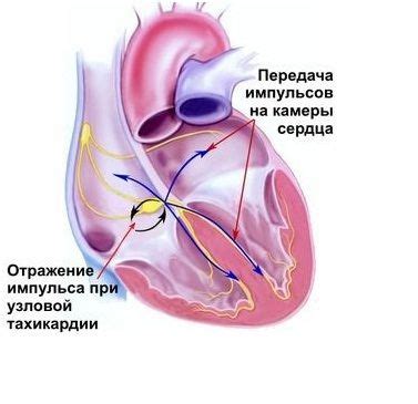 Лечение вертикальной эос синусовой тахикардии