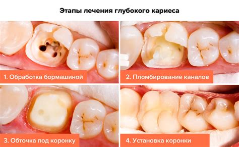 Лечение вырванного зуба: сроки, методы и процедуры