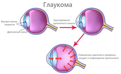 Лечение глаукомы печени