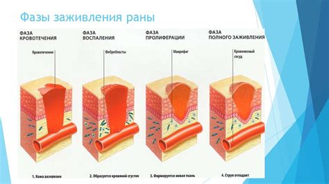 Лечение гнойно-некротической фазы раневого процесса