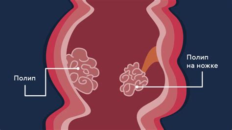 Лечение грануляционного полипа толстой кишки