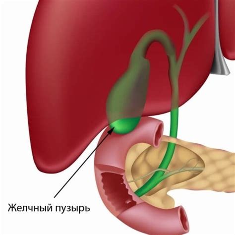 Лечение изгиба желчного пузыря