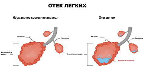 Лечение интерстициального отека легких