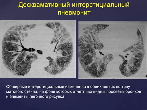 Лечение интерстициального поражения легких