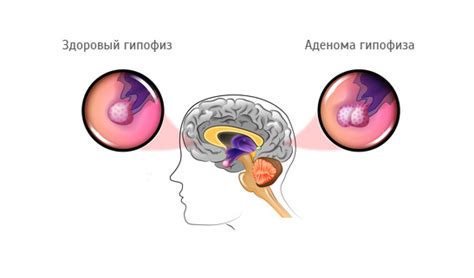 Лечение и профилактика истончения гипофиза