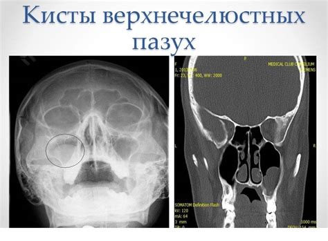 Лечение кисты левой верхнечелюстной пазухи