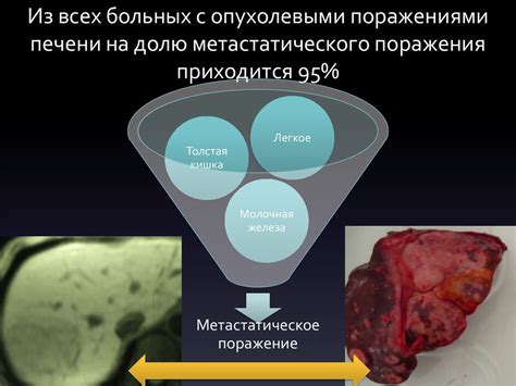 Лечение метастатического поражения печени