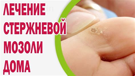 Лечение мозоли у ребенка: эффективные методы