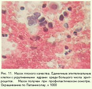 Лечение небольшого количества метаплазированного эпителия