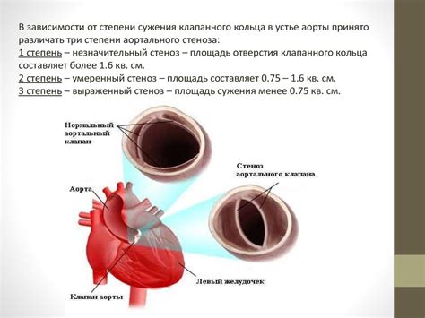 Лечение недостаточности клапанов МПВ