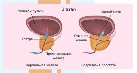 Лечение неопластического процесса предстательной железы