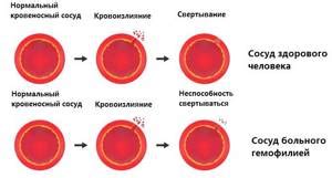 Лечение низкой свертываемости крови