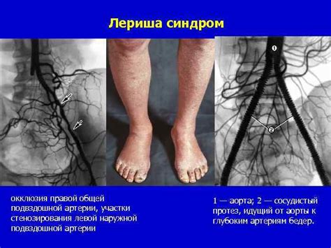 Лечение окклюзии артерий голени