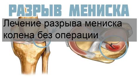 Лечение оторванного мениска без операции