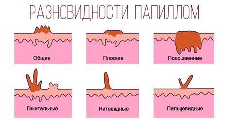 Лечение папиллом: