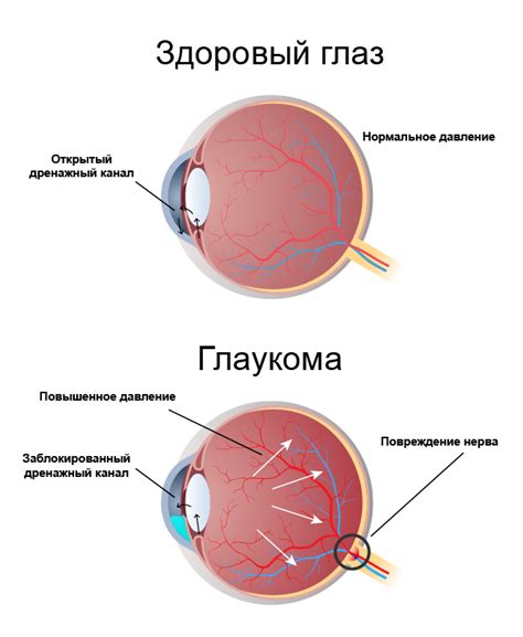 Лечение приступа глаукомы