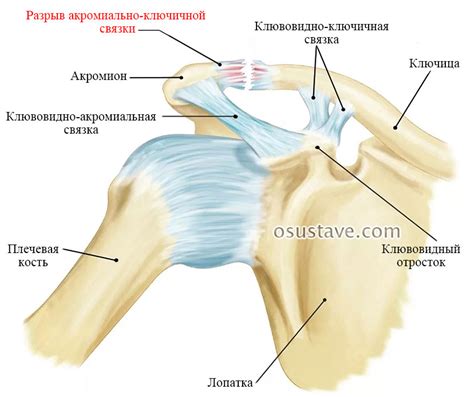 Лечение разрыва связок плечевого сустава