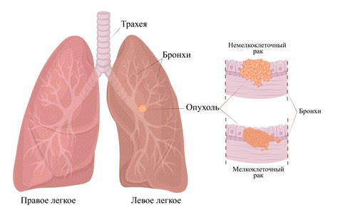 Лечение рака легких: методы и последствия