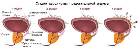 Лечение рака простаты Т2аномо