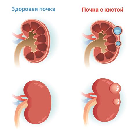 Лечение расширения лоханок почки