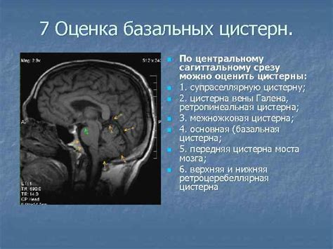 Лечение расширения цистерн основания мозга