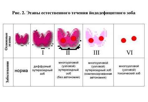 Лечение стадии декомпенсации щитовидной железы