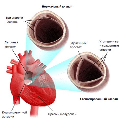 Лечение стеноза легочной артерии