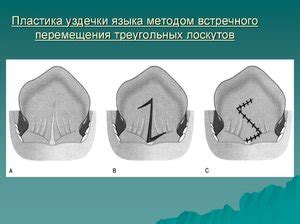 Лечение укороченной уздечки: возможности и методы