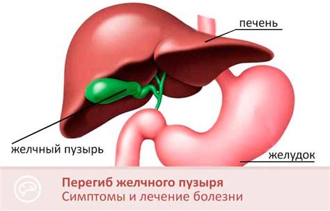 Лечение функционального перегиба желчного пузыря