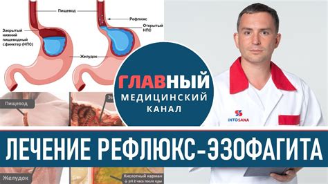 Лечение хронического рефлюкса эзофагита