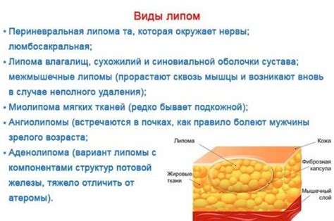 Липома: причины появления и способы удаления