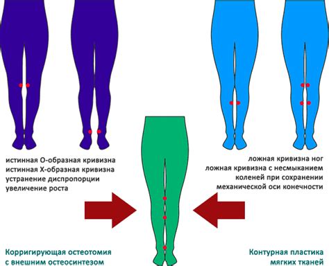 Ложная кривизна ног: причины и лечение