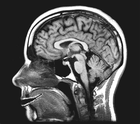 МРТ головного мозга с ангиографией сосудов: основные цели исследования
