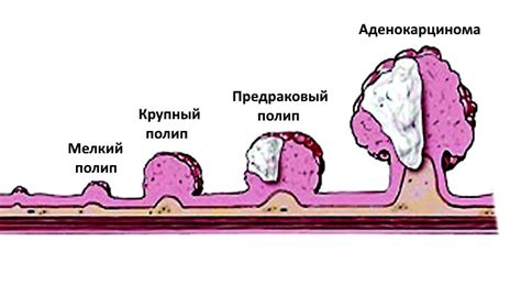 Малигнизация полипа: определение и последствия