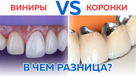 Материалы, из которых изготавливаются виниры и коронки