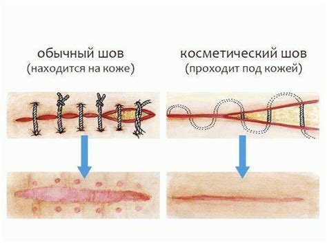 Материалы для косметического шва