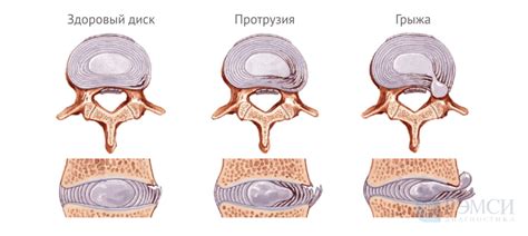 Медиально-парамедиальная грыжа: симптомы, причины и лечение