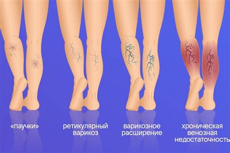 Медикаментозное лечение внутреннего варикоза ног