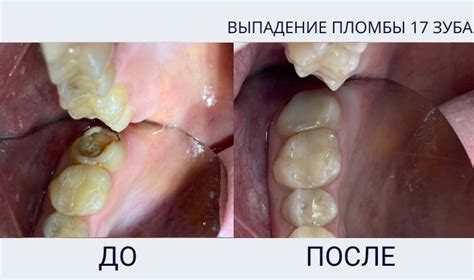 Медицинские факторы, вызывающие безболезненное и безкровное выпадение зуба