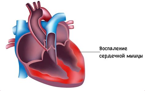 Метаболические процессы в миокарде: разрушение и его причины