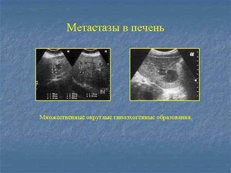 Метастазы печени: причины, симптомы и методы лечения