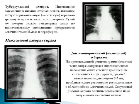 Методы диагностики и выявления туберкулемы легких