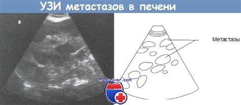 Методы диагностики метастазов печени