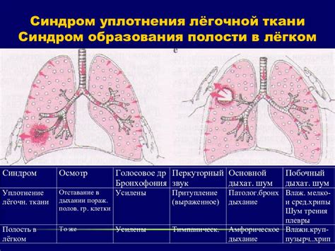 Методы диагностики уплотнения корней легких