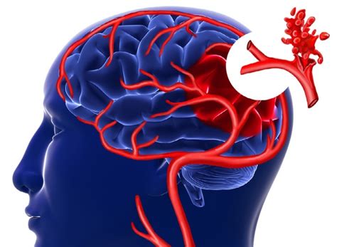 Методы лечения аневризмы сосудов головного мозга