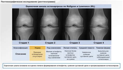 Методы лечения гонартроза