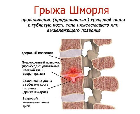 Методы лечения грыжи шморля грудного отдела