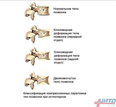 Методы лечения клиновидной деформации позвонков