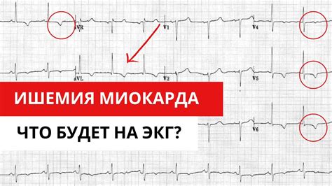 Методы лечения низкоамплитудной ЭКГ у женщин